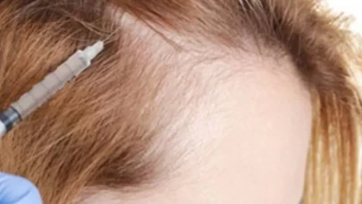 Kendi kanınızla saçlarınız geri geliyor