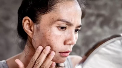 Güneş lekelerine veda edin! Cildi yenileyen en etkili doğal yağlar ortaya çıktı