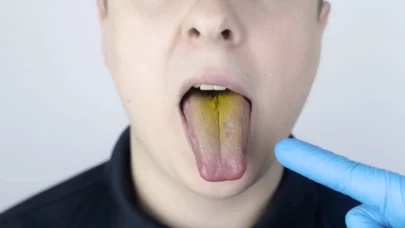 Dil rengi neden değişir? Hangi hastalığın habercisi