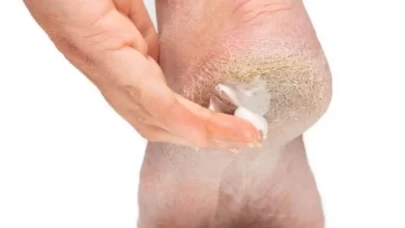 Kuru ve sert topuklara 5 doğal çözüm