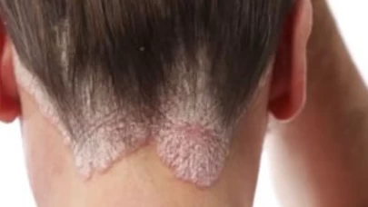 Evde uygulanabilecek en etkili 5 doğal yöntem