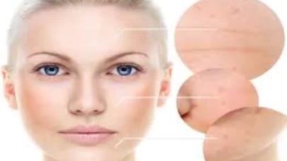 Evde uygulanabilecek gözenek küçültücü bakım önerileri