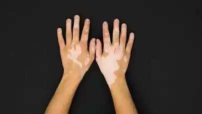 Vitiligo Nedir? Ciltte Beyaz Lekeler Neden Oluşur?