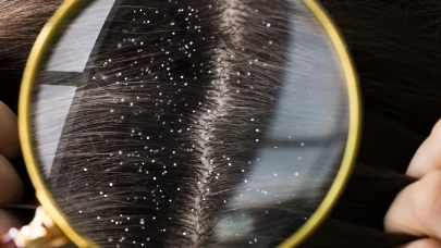 Sıcak su saç diplerinde kepek yapar mı?