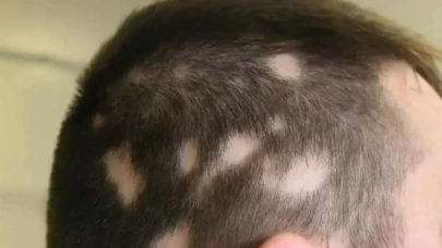 Saçkıran İçin Bitkisel Çözümler! Evde Doğal Yöntemlerle Saçkıran Nasıl Tedavi Edilir?