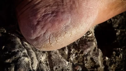 Topuk çatlakları neden oluşur? Evde onarım yöntemleri