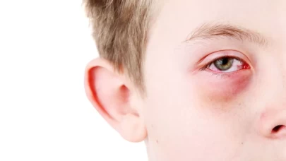 Bahar Geldi, Göz Alerjisi Kapıda! Peki, Korunmak İçin Ne Yapmalısınız?