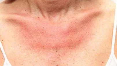 Güneş alerjisi olanlar için kritik uyarı! İşte en tehlikeli saatler