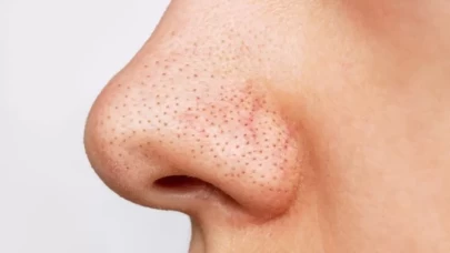 Komedon oluşumunu önlemek için günlük cilt bakımı ipuçları