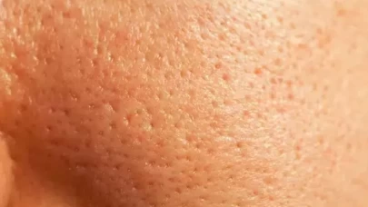 Portakal kabuğu ile yüzdeki derin gözenekleri küçültmek mümkün