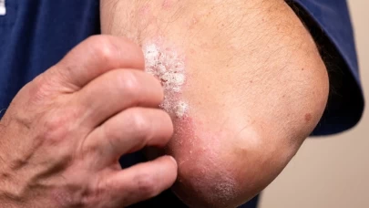 Cilt sorunlarına doğal çözüm: Eskilerden gelen şifa tarifi