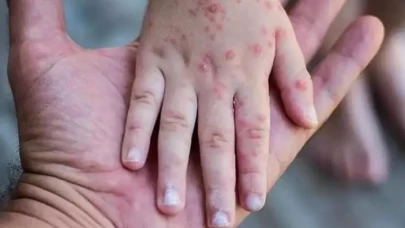 Liberya, M çiçeği virüsü için 10 bin doz aşı aldı