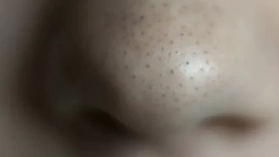 Cildinizdeki siyah noktalardan kurtulmanın doğal yolları neler?