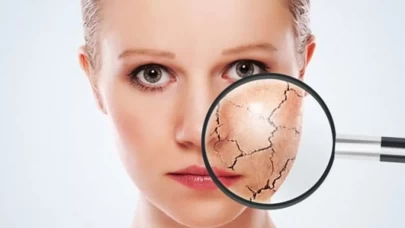 Cildiniz su diye haykırıyor! Kuruluk ve pullanma alarmı