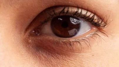 Evde göz altı morluklarını geçirebilecek doğal yöntemler