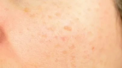 Limon cilt lekelerine iyi gelir mi?