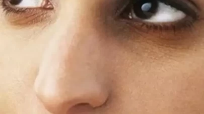 Göz altı morluklarına ne iyi gelir?