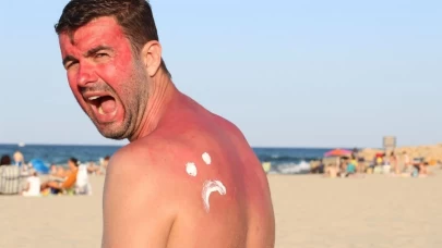 Bu yaz başka yaz! Güneş yanığı olmayın