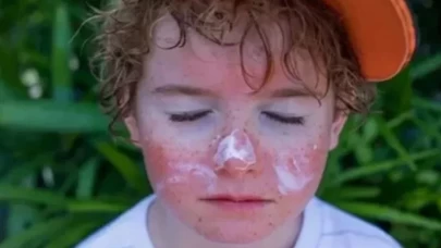 Güneş yanığına yoğurt sürülür mü?