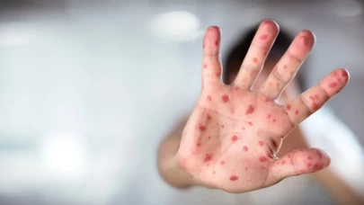 ABD’de kızamık vakaları 33 yılın zirvesinde