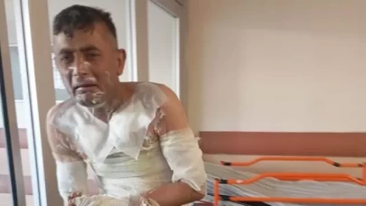 Engelli bireyin üzerine kimyasal sıvı döküp yaktı!
