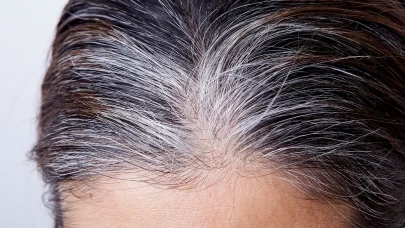 Beyazlayan saçlarının asıl nedeni ortaya çıktı! Meğer her şeye sebep o hormonmuş