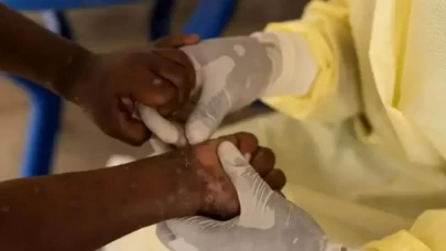 Gana'da M çiçeği virüsü kaynaklı ilk ölüm kaydedildi