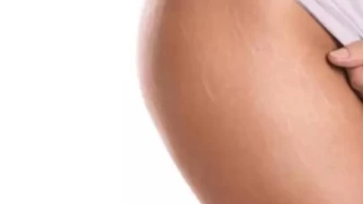 Vücut çatlakları için hemen uygulayabileceğiniz basit çözümler