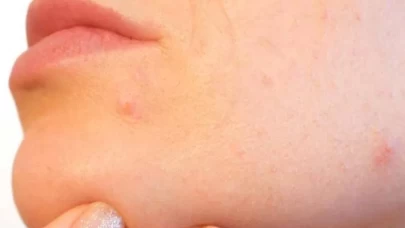 Hamilelikte cilt sorunlarıyla başa çıkmanın 5 doğal yolu