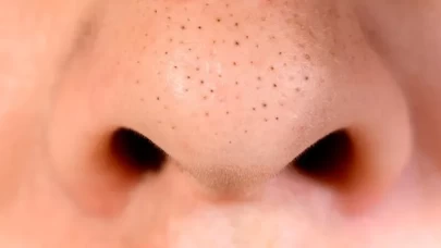 Siyah nokta temizliği nasıl yapılmalı?