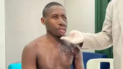 Yüzü yanan Ugandalı çoban Ankara'da tedavi edildi