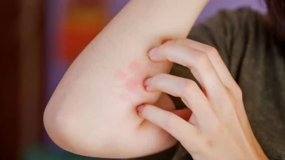 Böcek ısırığına karşı ilk müdahale ne olmalı?