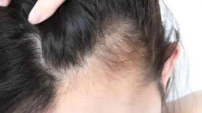 Ölü saç kökleri saç dökülmesinin en önemli sebebi