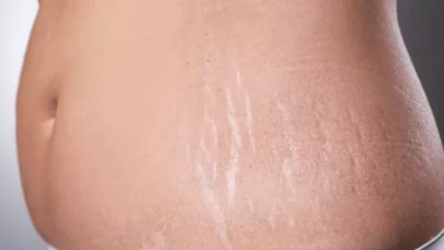 Hamilelikte Cilt Çatlaklarını Önlemenin Püf Noktaları