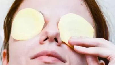 Göze patates koymanın faydaları