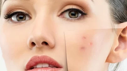 Akne lekelerine karşı en etkili gece rutini