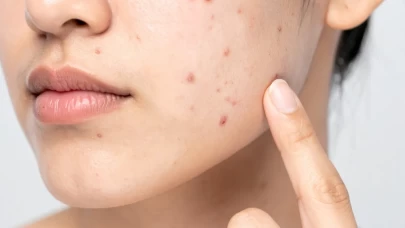 Ciltte ani sivilce patlaması ne anlatıyor?