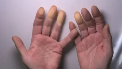 Raynaud hastalığı belirtileri nelerdir?