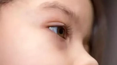 Çocuklarda göz altı koyu halkalar neden oluşur?