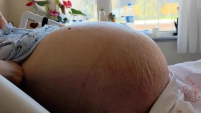 Kabızlık sandı hastaneye gidince şok oldu! Tam 22 kilo... Doktorlar inanamadı