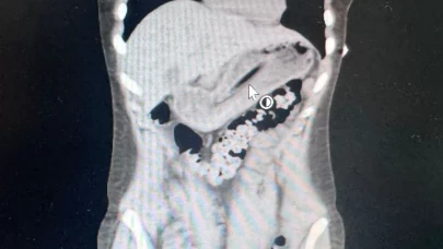Kusmak için boğazına soktuğu diş fırçasını yuttu! Doktorlar bile inanamadı