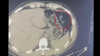 Diyarbakır'da iki kişinin midelerinden çıkanlar şaşkına çevirdi