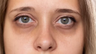 Göz altı morlukları neden olur? Oluşmasına yol açan etkenler