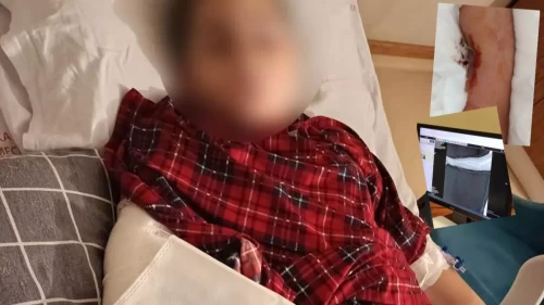 9 yaşındaki çocuk arkadaşının kolunu iki yerinden kırdı!