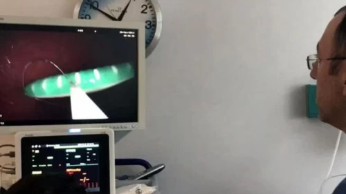 Kusmak için boğazına soktuğu diş fırçasını yuttu! Doktorlar bile inanamadı