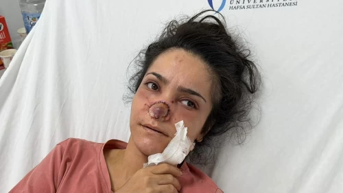 Manisa’da eşinin saldırısında burnu kopan kadına ameliyat