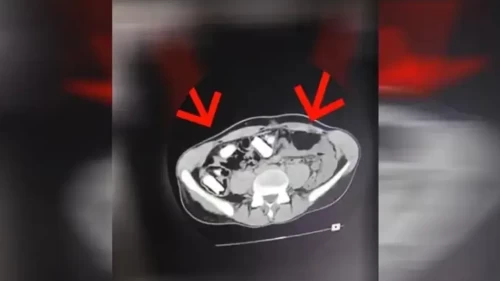 Erzincan'da mide ve bağırsaklarında metamfetamin ele geçirilen şüpheli tutuklandı