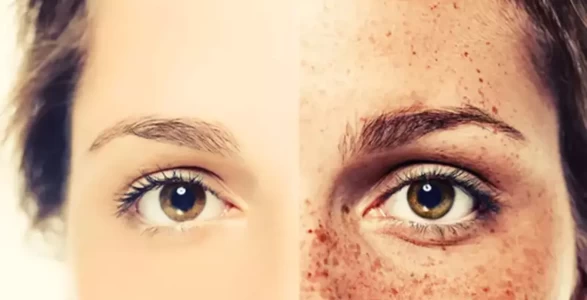 Doğal yöntemlerle çilleri azaltın! En etkili ev yapımı maske tarifi