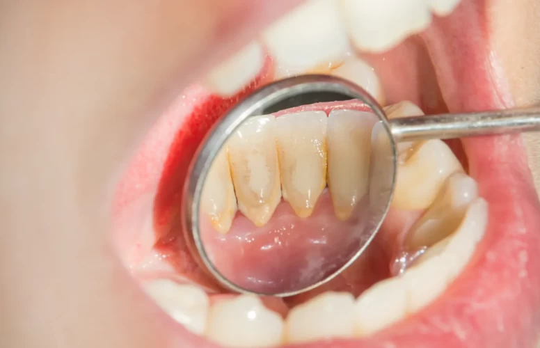 Küçücük diş eti taşları ölümcül riski ortaya çıkarıyor