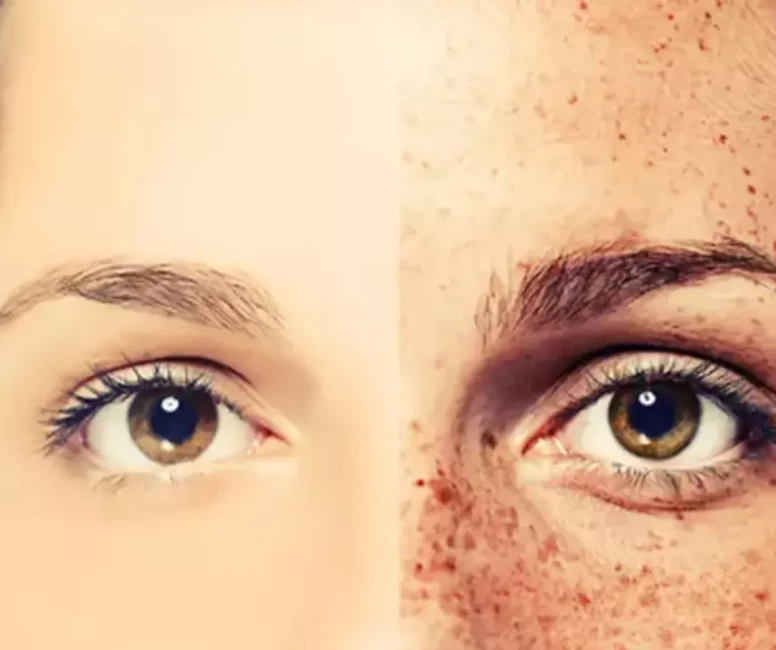 Doğal yöntemlerle çilleri azaltın! En etkili ev yapımı maske tarifi